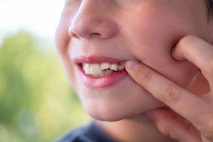 Bambino con denti storti