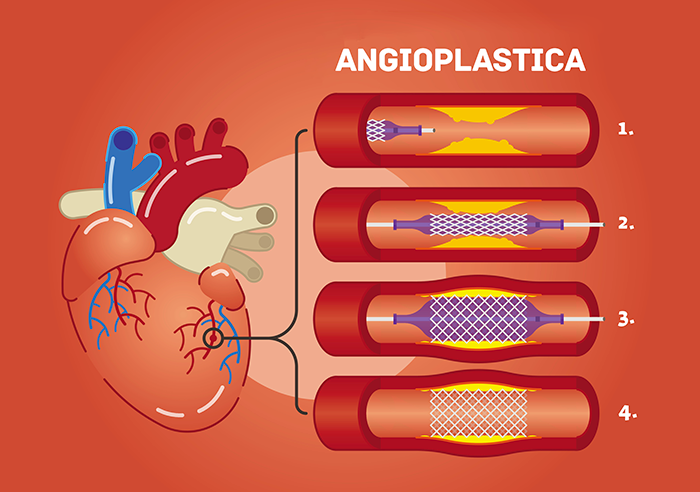 Il funzionamento dell'angioplastica