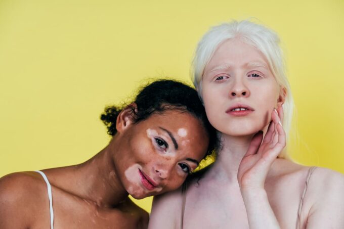 Vitiligine e albinismo